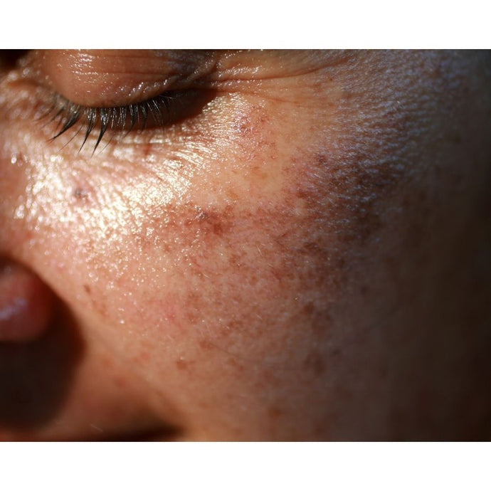 Hudhelse GRATIS hudscanning/ analyse i september