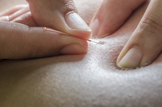 Kurs i dry needling-smertebehandling kurs